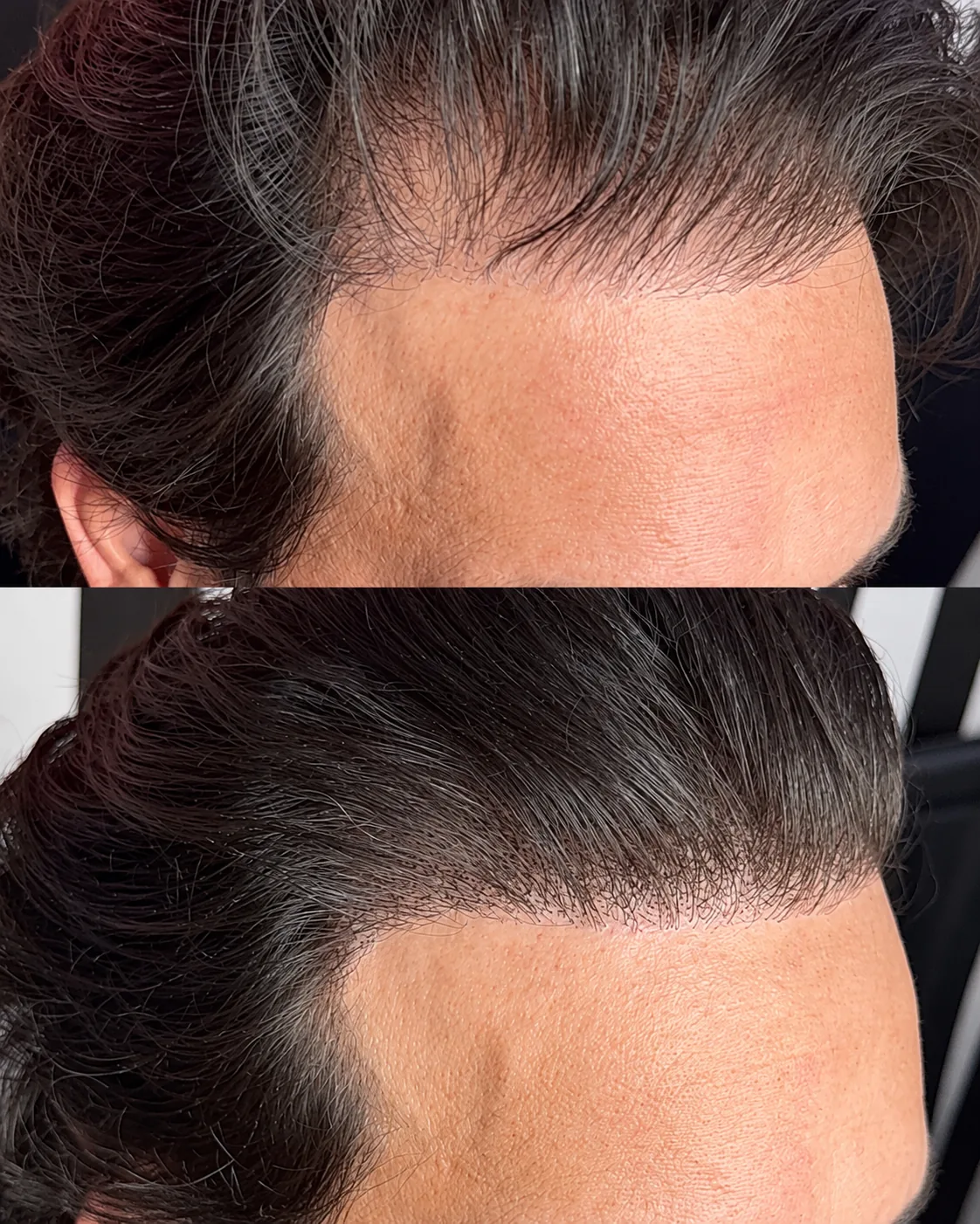 Scalp microblading before and after: a receding front hairline, then the same hairline filled in with fine hair strokes